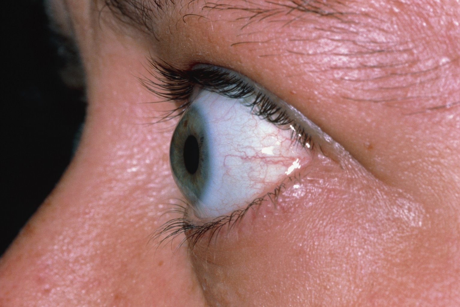 علاج جحوظ العين (بروز العين) في ايران 1